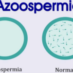 Azoospermia