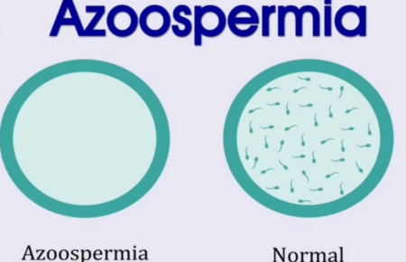 Azoospermia