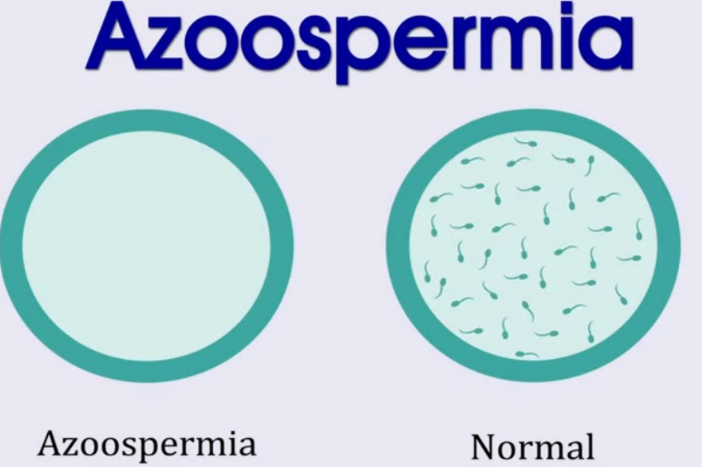 What Is Azoospermia, and What Causes Explained Azoospermia